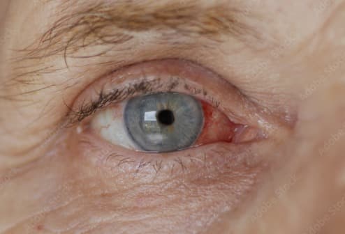 Cataract Surgery