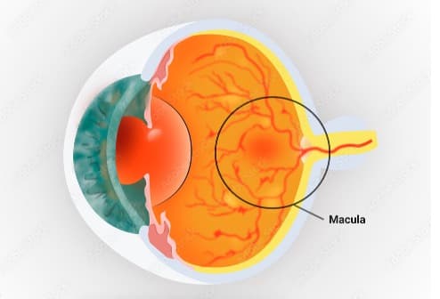 Macular Degenration