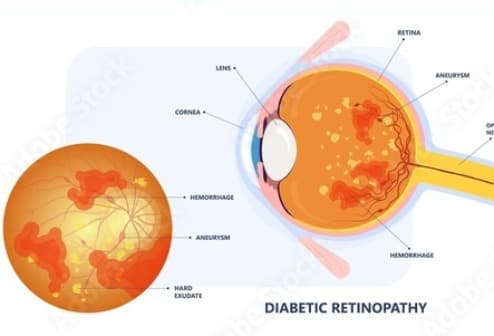 Diabetic Retinopathy